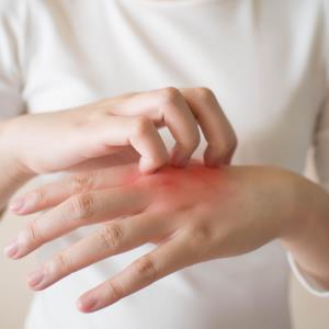 Ivarmacitinib shows favourable risk–benefit profile in AD