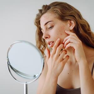 Denifanstat reduces lesions in acne vulgaris