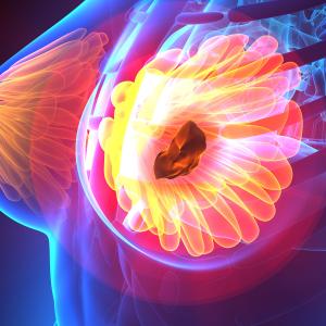 Dose reduction does not limit efficacy of trastuzumab deruxtecan in MBC