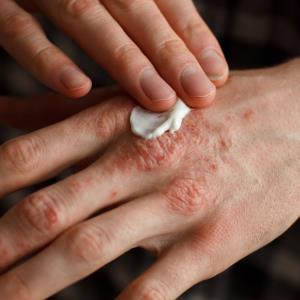 Apremilast trims fat mass, reducing CV events in PsA