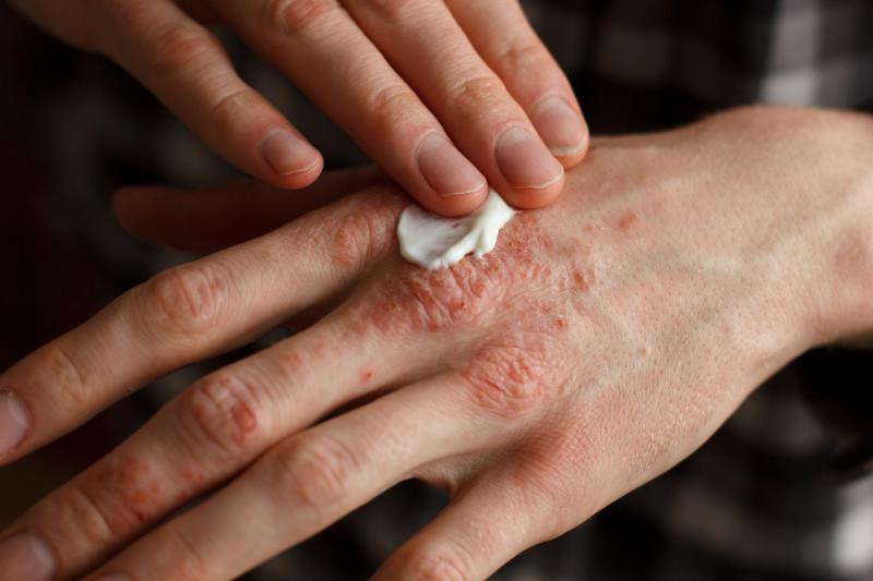 Apremilast trims fat mass, reducing CV events in PsA patients