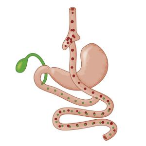 Bariatric surgery more effective, affordable than GLP-1RAs for severe obesity