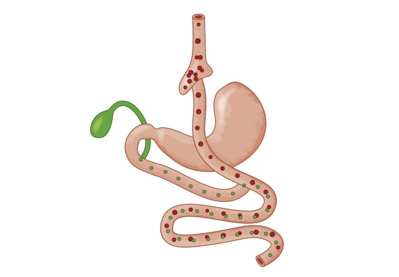 Bariatric surgery more effective, affordable than GLP-1RAs for severe obesity