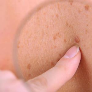 Frontline nelitolimod plus pembrolizumab combo elicits response in advanced melanoma