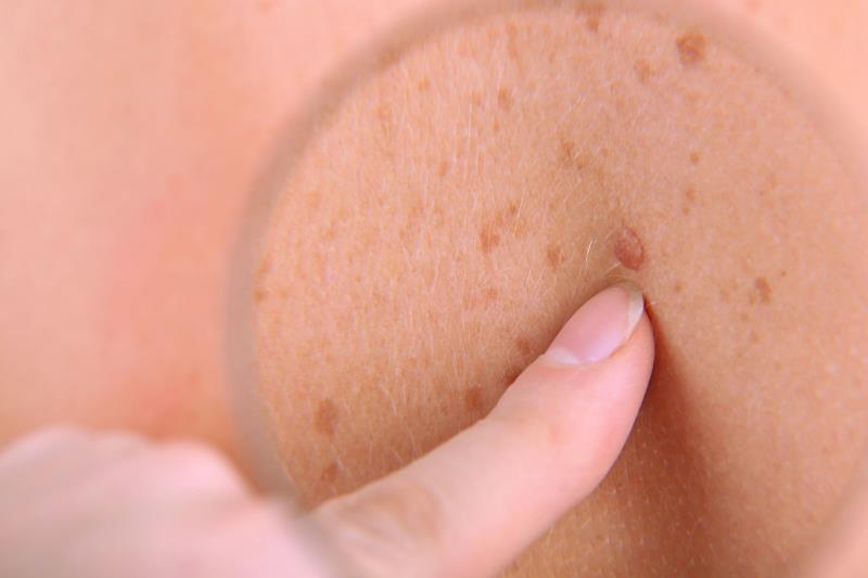 Frontline nelitolimod plus pembrolizumab combo elicits response in advanced melanoma