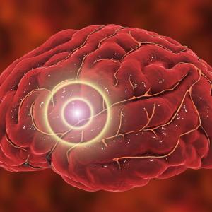 Outcomes in ICH patients not different with minimally invasive surgery vs medical management