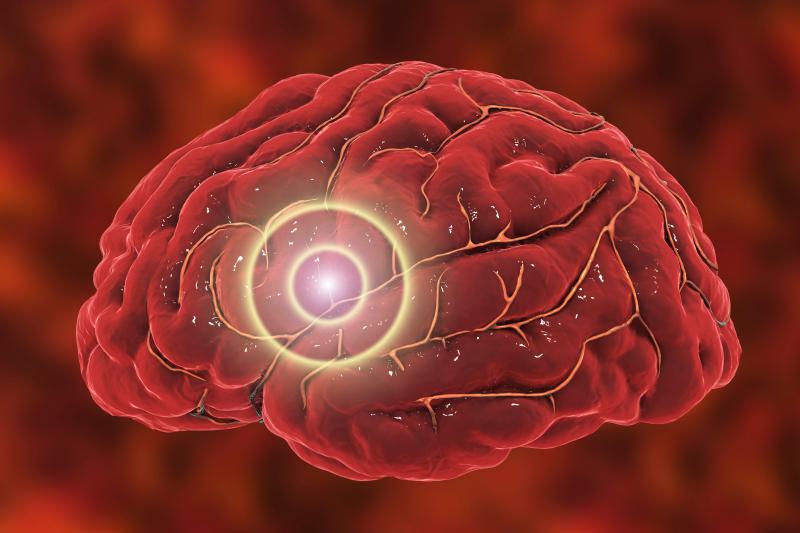 Outcomes in ICH patients not different with minimally invasive surgery vs medical management