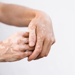 Cell harvesting device delivers repigmentation in stable vitiligo lesions
