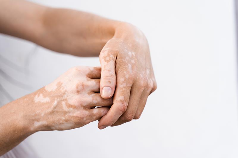 Cell harvesting device delivers repigmentation in stable vitiligo lesions