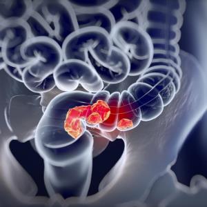 Primary sclerosing cholangitis an independent risk factor for colorectal cancer