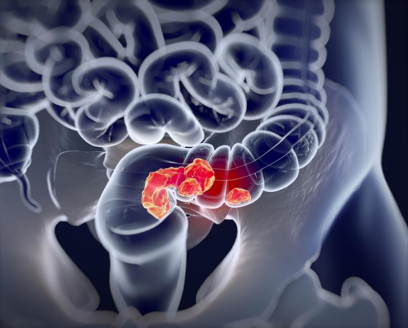 Primary sclerosing cholangitis an independent risk factor for colorectal cancer
