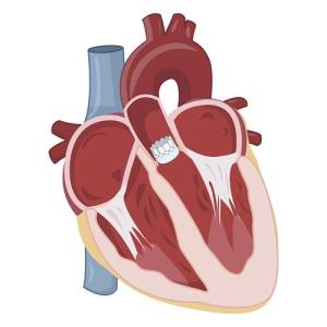 Which anticoagulation intensity works best for Asians with mitral stenosis?
