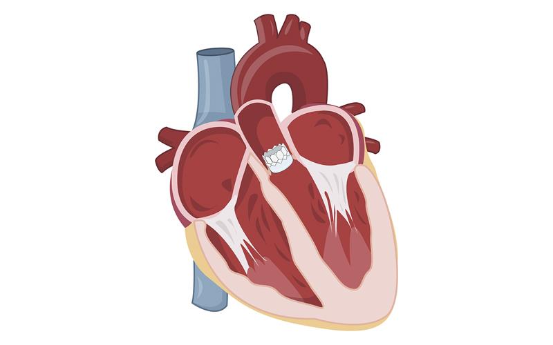 Which anticoagulation intensity works best for Asians with mitral stenosis?