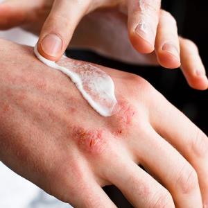 Delgocitinib cream safe, effective for long-term use in eczema