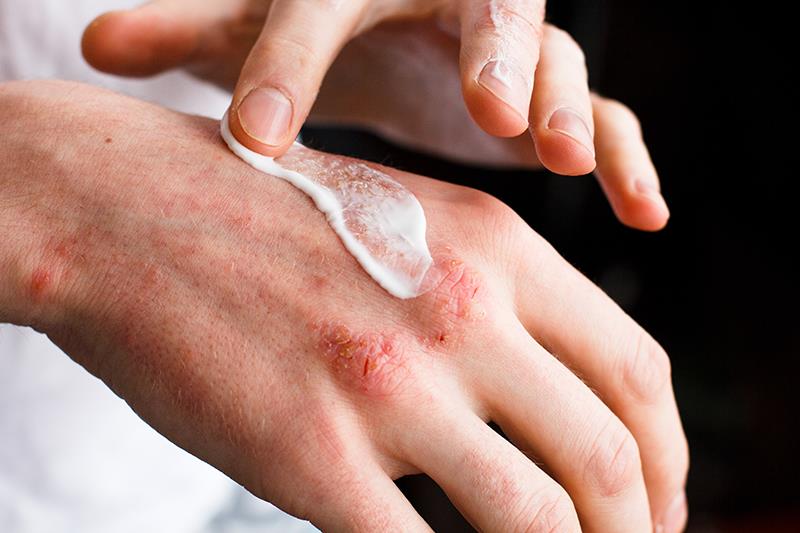 Delgocitinib cream safe, effective for long-term use in chronic hand eczema