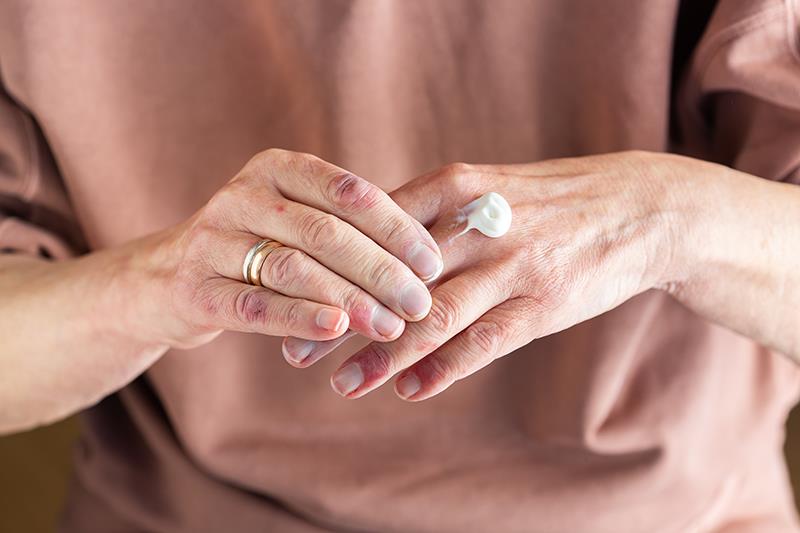 Delgocitinib cream works wonders in chronic hand eczema