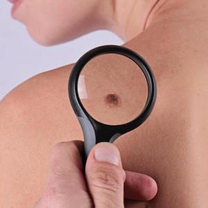 ICIs improve survival in advanced MCC at population level