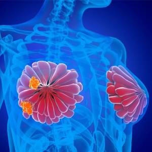DESTINY-Breast09: T-DXd plus pertuzumab improves PFS in HER2+ breast cancer