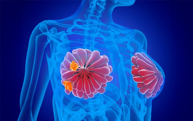 DESTINY-Breast09: T-DXd plus pertuzumab improves PFS in HER2+ breast cancer