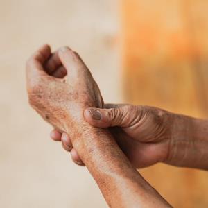 Deucravacitinib delivers long-term efficacy in PsA