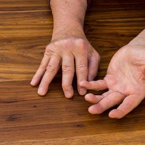Deucravacitinib delivers superior efficacy, safety in active PsA