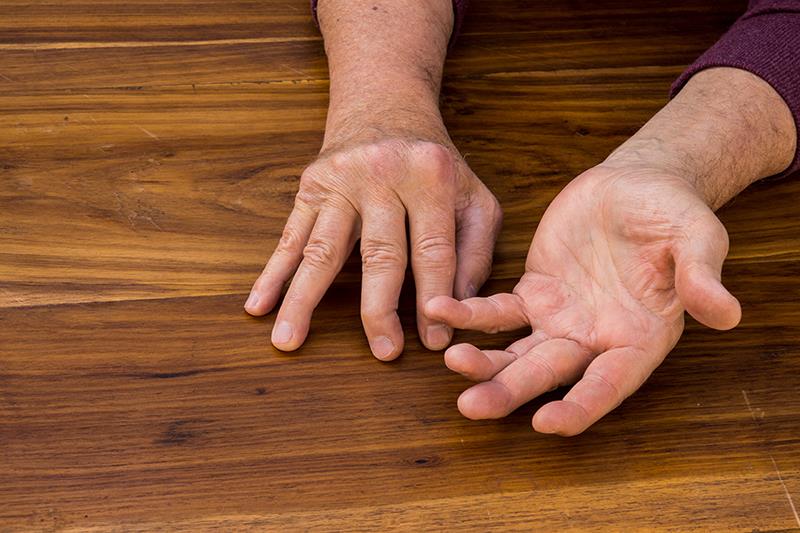 Deucravacitinib delivers superior efficacy, safety in active PsA