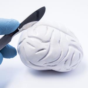 What stops patients in SG from getting surgery for drug-resistant epilepsy?