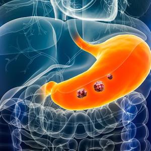 Durvalumab plus FLOT improves event-free survival in gastric, GEJ adenocarcinoma