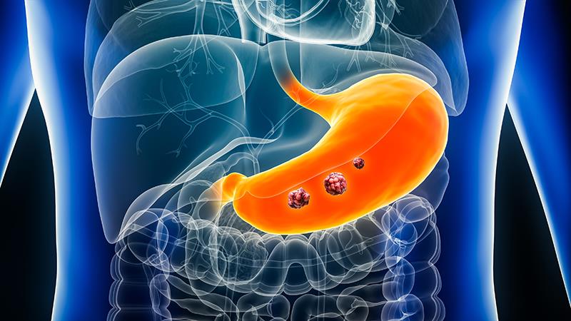 Durvalumab plus FLOT improves event-free survival in gastric, GEJ adenocarcinoma