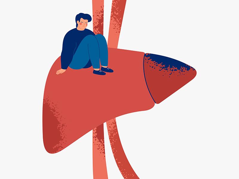 Efruxifermin reduces fibrosis in MASH cirrhosis
