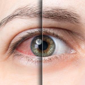 Teprotumumab outclasses glucocorticoids in thyroid eye disease
