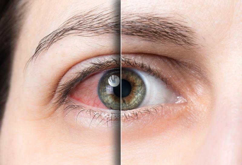 Teprotumumab outclasses glucocorticoids in thyroid eye disease