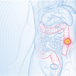 Personalized risk messages improve CRC screening uptake