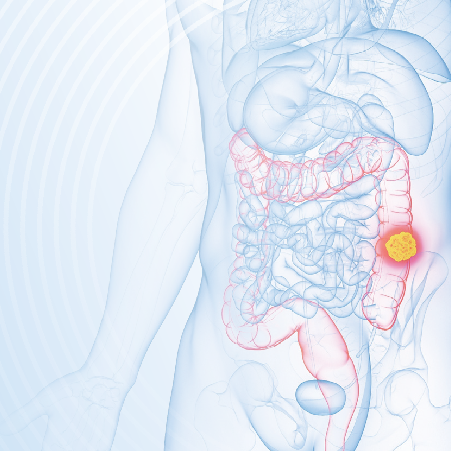 Encorafenib plus cetuximab for treatment of BRAFV600E-mutant metastatic colorectal cancer: A case study