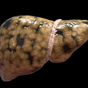 NAFLD/MAFLD carries increased risk of nephrolithiasis