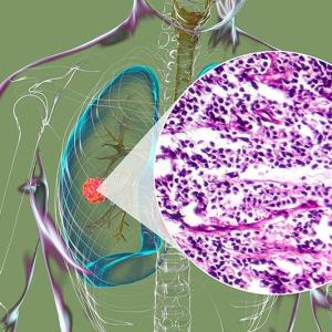 First-line atezolizumab plus CP/ET offers survival benefits in ES-SCLC