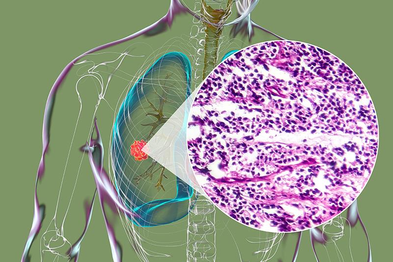 First-line atezolizumab plus CP/ET offers survival benefits in ES-SCLC