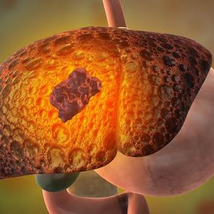 First-line durvalumab plus tremelimumab safe to use in unresectable HCC
