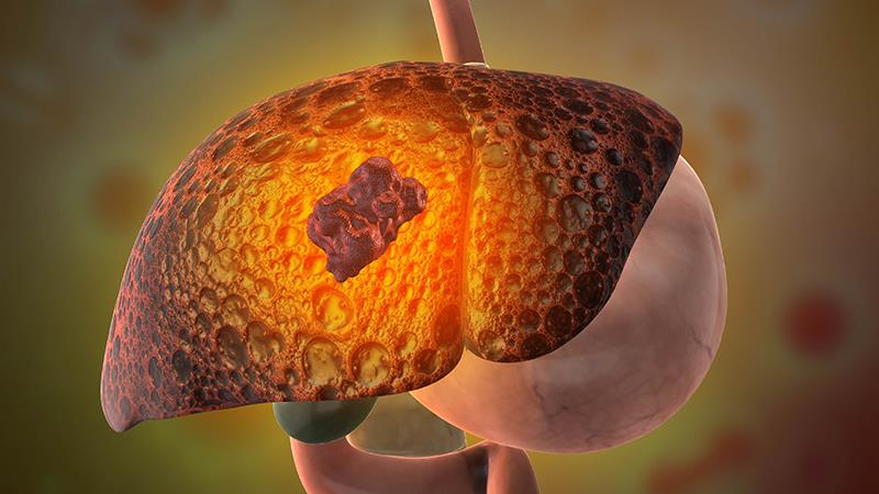 First-line durvalumab plus tremelimumab safe to use in unresectable HCC