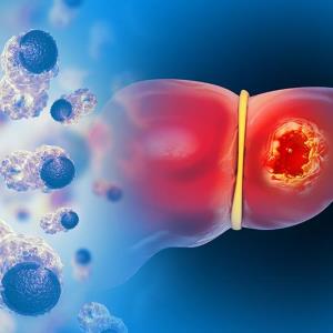 First-line NIVO plus IPI shows ORR, OS benefit in patients with HCC