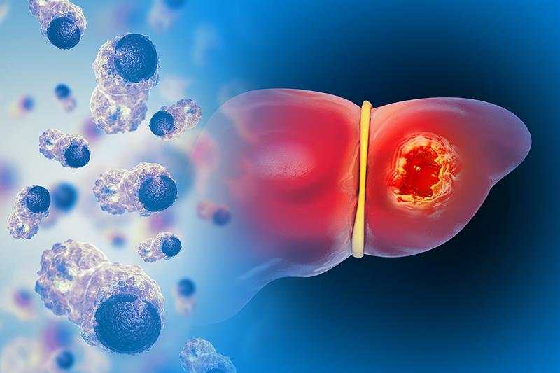 First-line NIVO plus IPI delivers ORR, OS benefits in patients with HCC