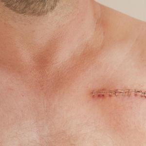 Mechanical vacuum aspiration improves outcomes after CIED extraction