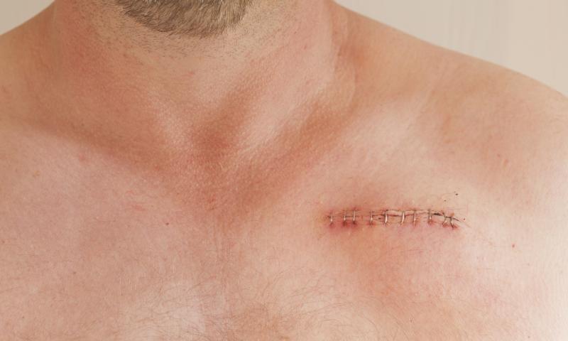 Mechanical vacuum aspiration improves outcomes after CIED extraction