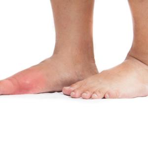 Empirical dietary index predicts risk of gout