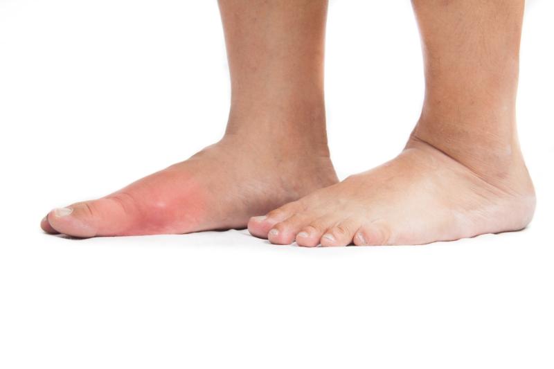 Empirical dietary index predicts risk of gout