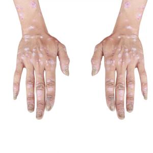 Risk of death higher in people with vs without psoriasis