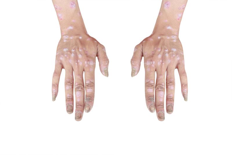 Risk of death higher in people with vs without psoriasis