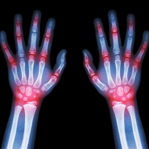 Dotinurad bests febuxostat for Chinese patients with gout