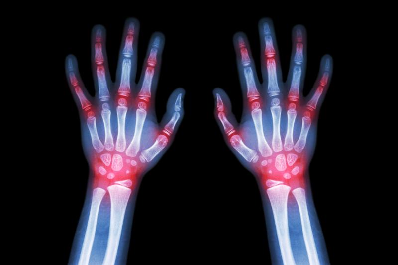 Dotinurad bests febuxostat for Chinese patients with gout