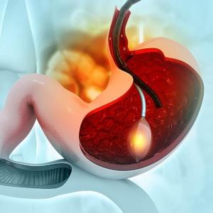 Coil plus glue therapy beneficial for gastric varices
